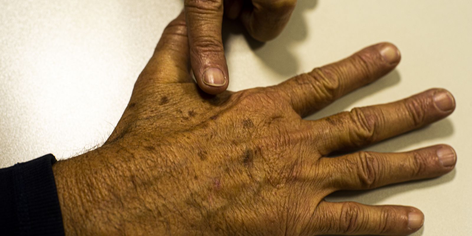 Dados incompletos sobre câncer de pele no Brasil dificultam diagnóstico e tratamento, aponta estudo
